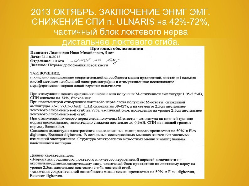 2013 ОКТЯБРЬ. ЗАКЛЮЧЕНИЕ ЭНМГ ЭМГ. СНИЖЕНИЕ СПИ n. ULNARIS на 42%-72%, частичный блок локтевого