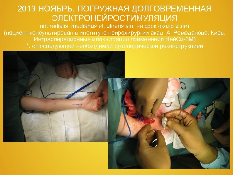 2013 НОЯБРЬ. ПОГРУЖНАЯ ДОЛГОВРЕМЕННАЯ ЭЛЕКТРОНЕЙРОСТИМУЛЯЦИЯ nn. radialis, medianus et. ulnaris sin. на срок около