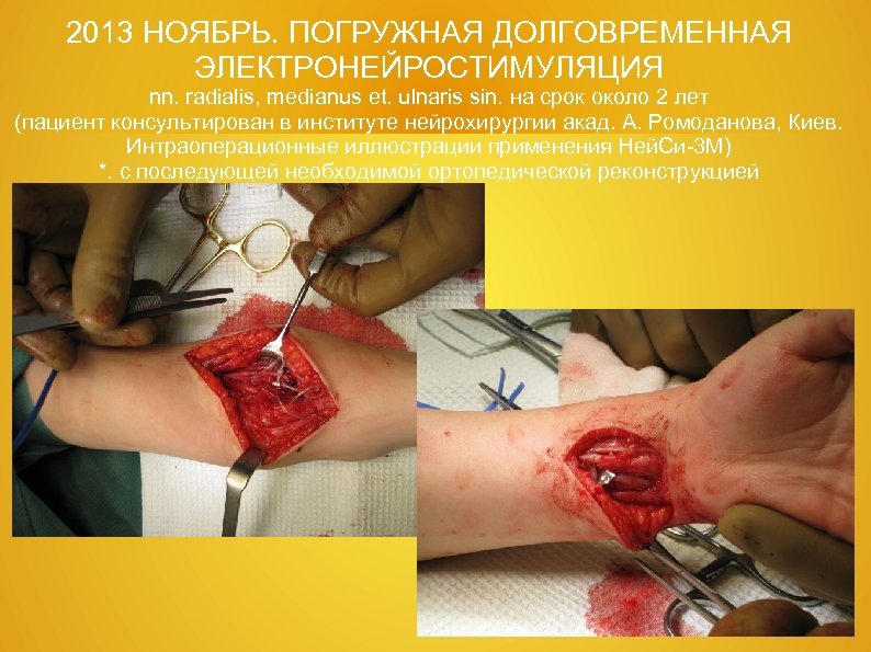 2013 НОЯБРЬ. ПОГРУЖНАЯ ДОЛГОВРЕМЕННАЯ ЭЛЕКТРОНЕЙРОСТИМУЛЯЦИЯ nn. radialis, medianus et. ulnaris sin. на срок около