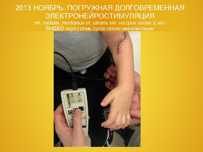 2013 НОЯБРЬ. ПОГРУЖНАЯ ДОЛГОВРЕМЕННАЯ ЭЛЕКТРОНЕЙРОСТИМУЛЯЦИЯ nn. radialis, medianus et. ulnaris sin. на срок около