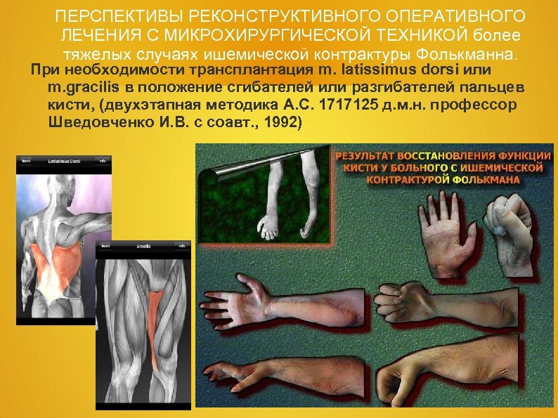 ПЕРСПЕКТИВЫ РЕКОНСТРУКТИВНОГО ОПЕРАТИВНОГО ЛЕЧЕНИЯ С МИКРОХИРУРГИЧЕСКОЙ ТЕХНИКОЙ более тяжелых случаях ишемической контрактуры Фолькманна. При