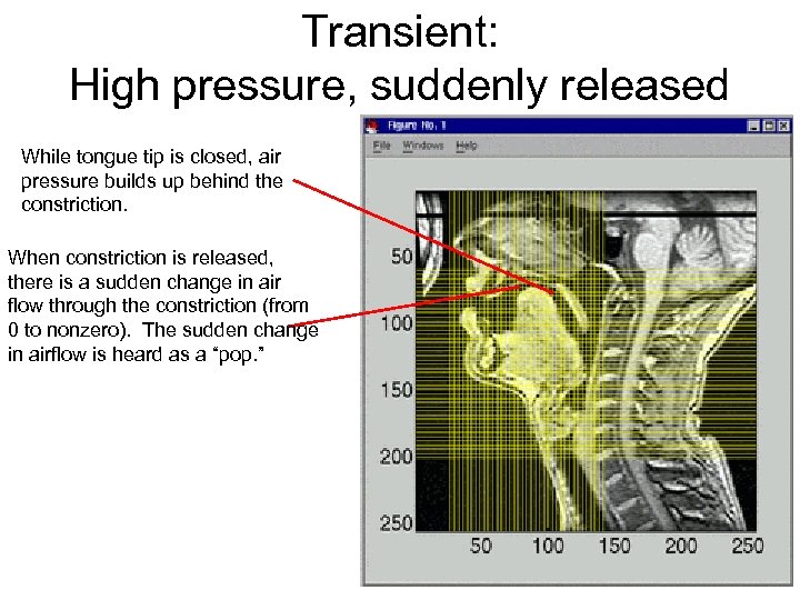 Transient: High pressure, suddenly released While tongue tip is closed, air pressure builds up