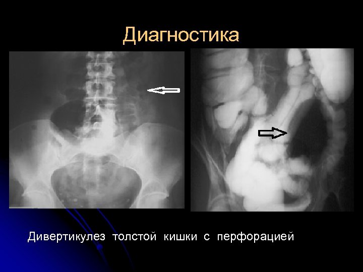 Диагностика Дивертикулез толстой кишки с перфорацией 