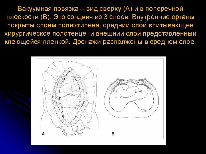 Вакуумная повязка – вид сверху (A) и в поперечной плоскости (B). Это сэндвич из