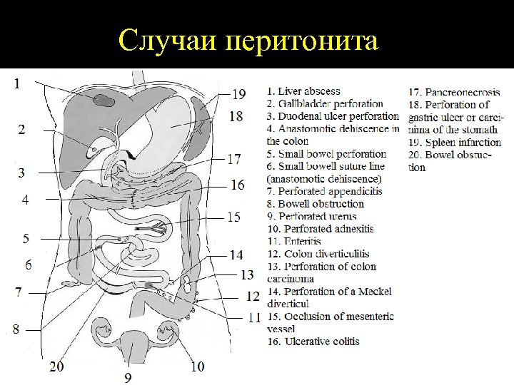 Случаи перитонита 