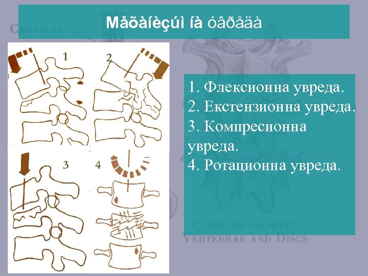 Мåõàíèçúì íà óâðåäà 1 3 2 4 1. Флексионна увреда. 2. Екстензионна увреда. 3.