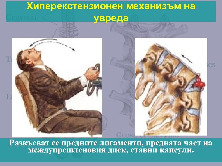 Хиперекстензионен механизъм на увреда Разкъсват се предните лигаменти, предната част на междупрешленовия диск, ставни
