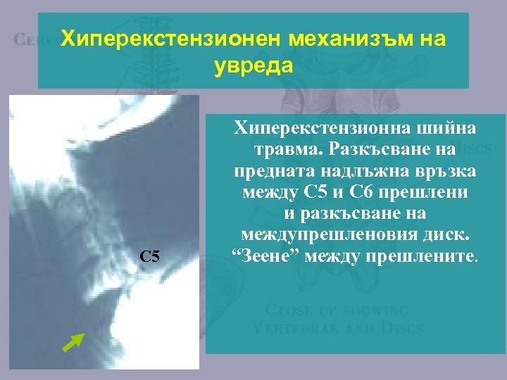 Хиперекстензионен механизъм на увреда C 5 Хиперекстензионна шийна травма. Разкъсване на предната надлъжна връзка