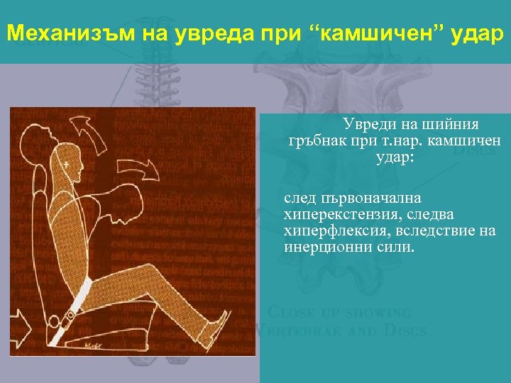 Механизъм на увреда при “камшичен” удар Увреди на шийния гръбнак при т. нар. камшичен