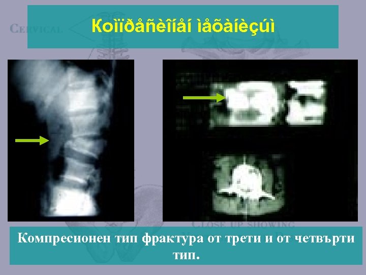 Кoìïðåñèîíåí ìåõàíèçúì L 3 Компресионен тип фрактура от трети и от четвърти тип. 
