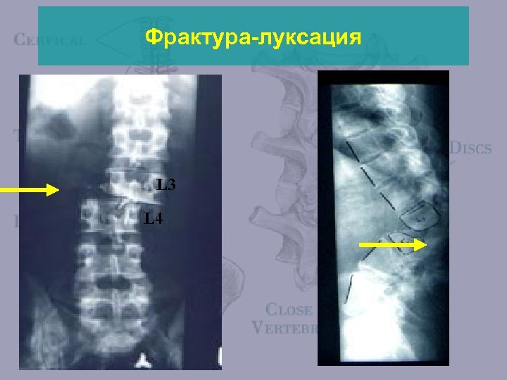 Фрактура-луксация L 3 L 4 