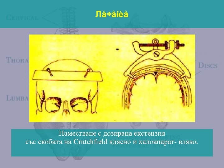 Лå÷åíèå Наместване с дозирана екстензия със скобата на Crutсhfield вдясно и халоапарат- вляво. 