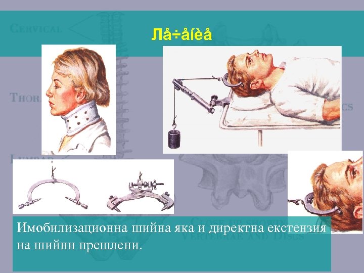 Лå÷åíèå Имобилизационна шийна яка и директна екстензия на шийни прешлени. 