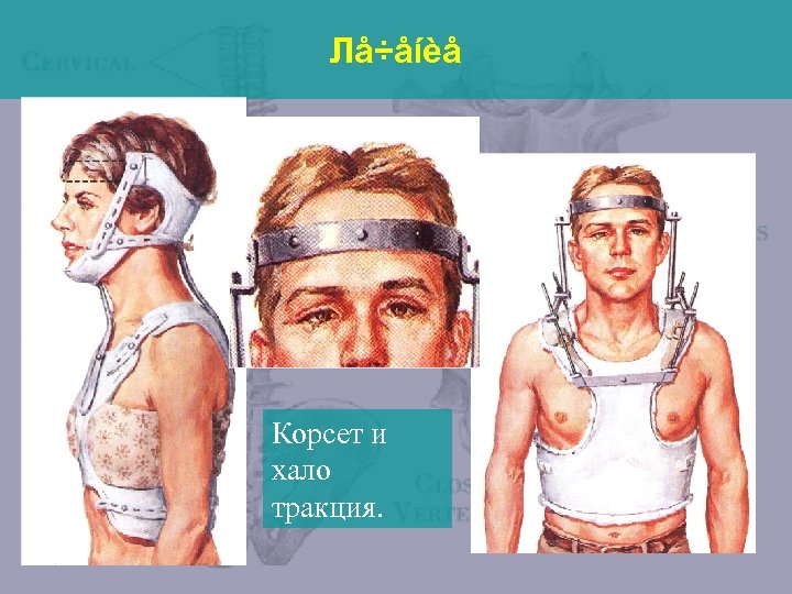 Лå÷åíèå Корсет и хало тракция. 