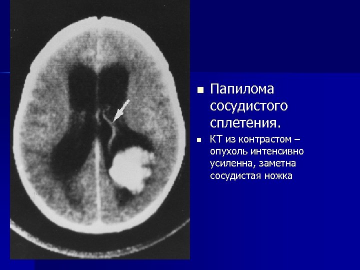 n n Папилома сосудистого сплетения. КТ из контрастом – опухоль интенсивно усиленна, заметна сосудистая