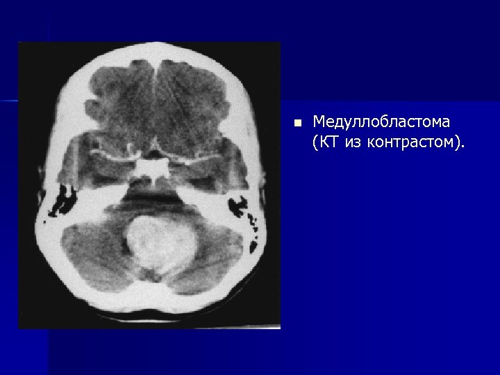 n Медуллобластома (КТ из контрастом). 