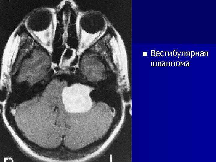 n Вестибулярная шваннома 