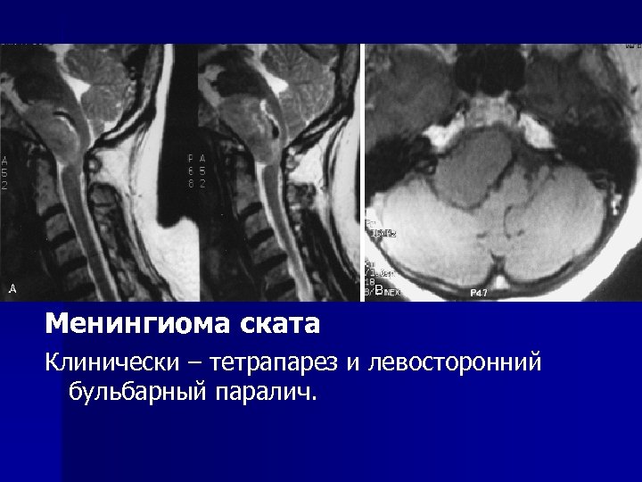 Опухоли головного и спинного мозга презентация