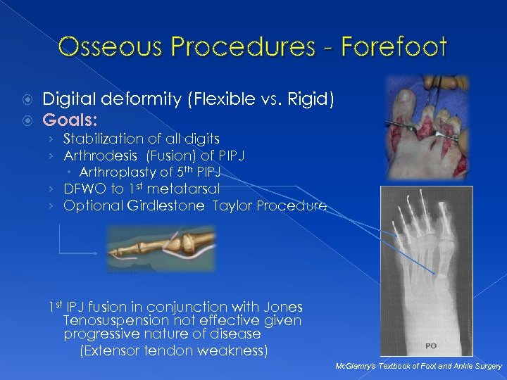 Osseous Procedures - Forefoot Digital deformity (Flexible vs. Rigid) Goals: › Stabilization of all