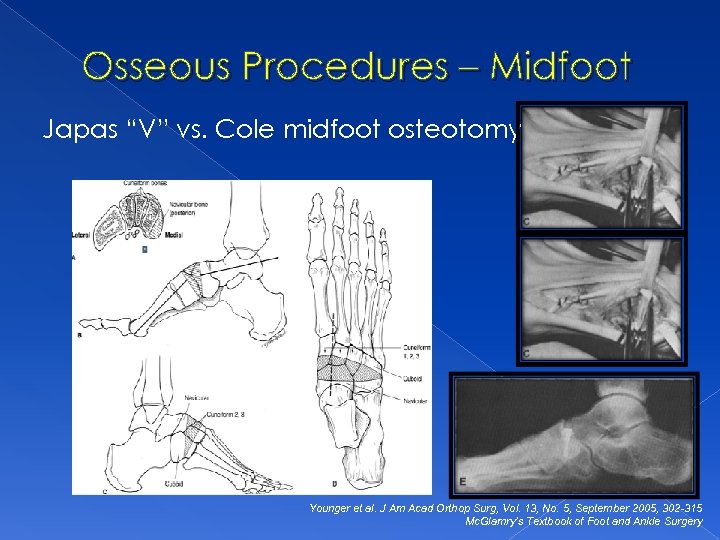 Osseous Procedures – Midfoot Japas “V” vs. Cole midfoot osteotomy Younger et al. J