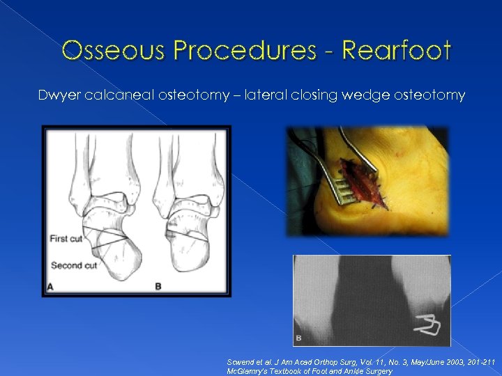 Osseous Procedures - Rearfoot Dwyer calcaneal osteotomy – lateral closing wedge osteotomy Scwend et