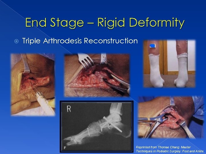 End Stage – Rigid Deformity Triple Arthrodesis Reconstruction Reprinted from Thomas Chang: Master Techniques