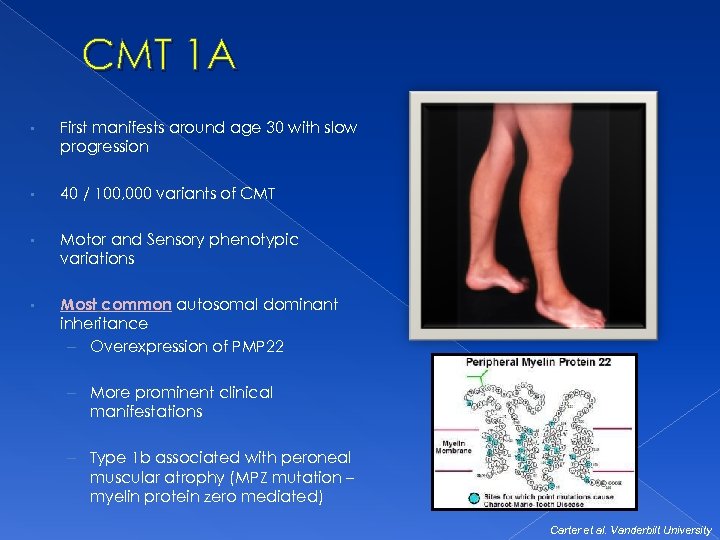 CMT 1 A • First manifests around age 30 with slow progression • 40