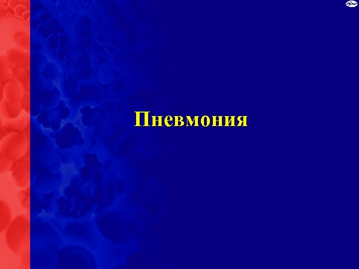 Пневмония 