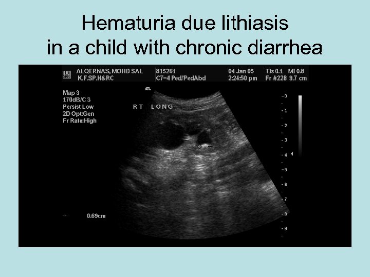 Hematuria due lithiasis in a child with chronic diarrhea 