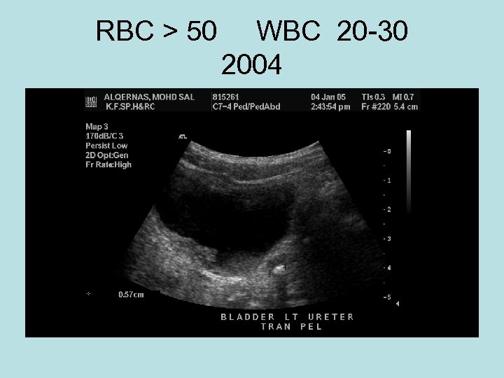 RBC > 50 WBC 20 -30 2004 