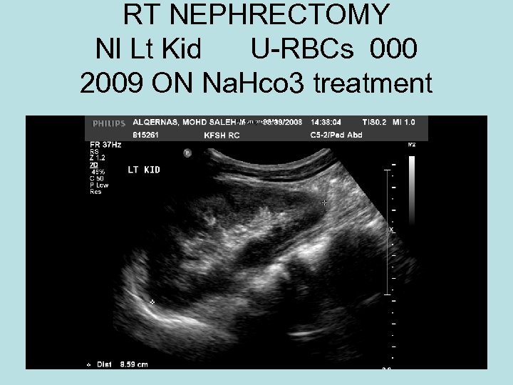 RT NEPHRECTOMY Nl Lt Kid U-RBCs 000 2009 ON Na. Hco 3 treatment 