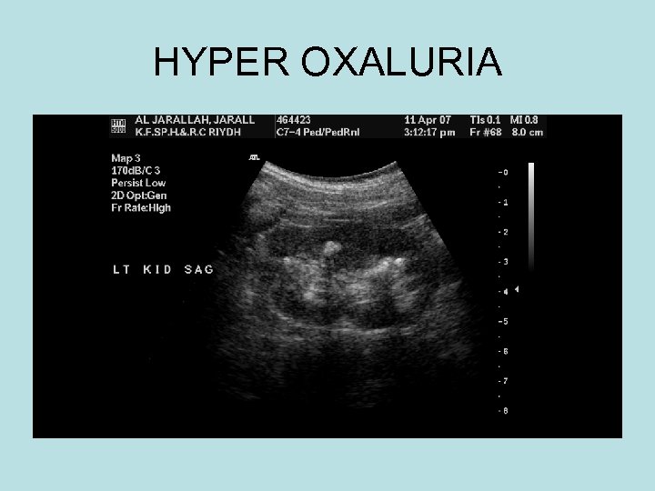 HYPER OXALURIA 