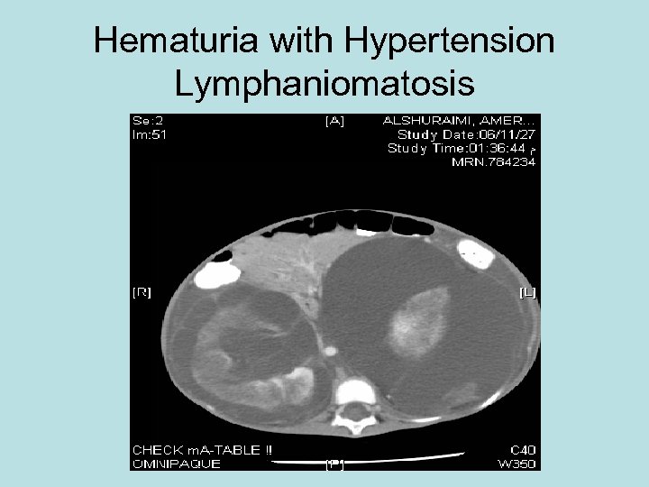 Hematuria with Hypertension Lymphaniomatosis 