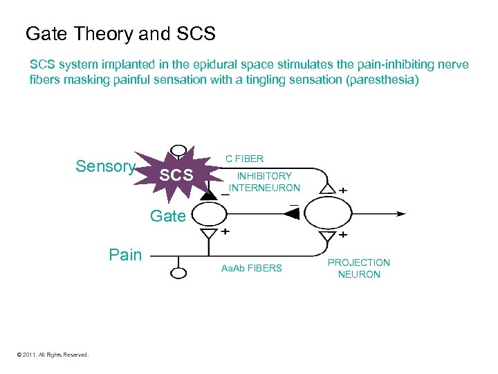 Gate Theory and SCS system implanted in the epidural space stimulates the pain-inhibiting nerve