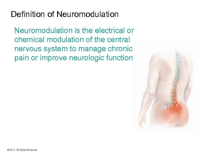 Definition of Neuromodulation is the electrical or chemical modulation of the central nervous system