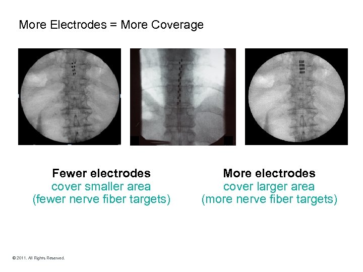 More Electrodes = More Coverage Fewer electrodes cover smaller area (fewer nerve fiber targets)