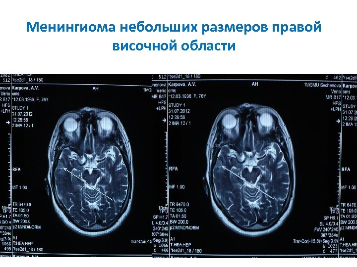 Дисциркуляторная энцефалопатия на фоне гб