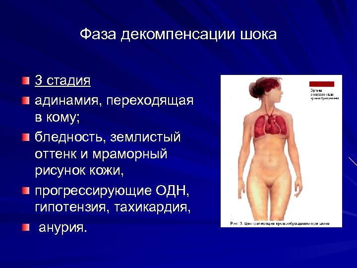 Фаза декомпенсации шока 3 стадия адинамия, переходящая в кому; бледность, землистый оттенк и мраморный