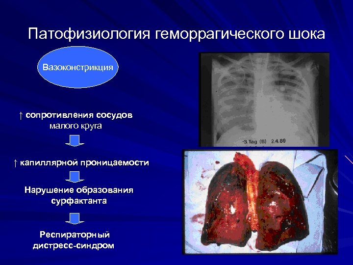 Патофизиология геморрагического шока Вазоконстрикция ↑ сопротивления сосудов малого круга ↑ капиллярной проницаемости Нарушение образования
