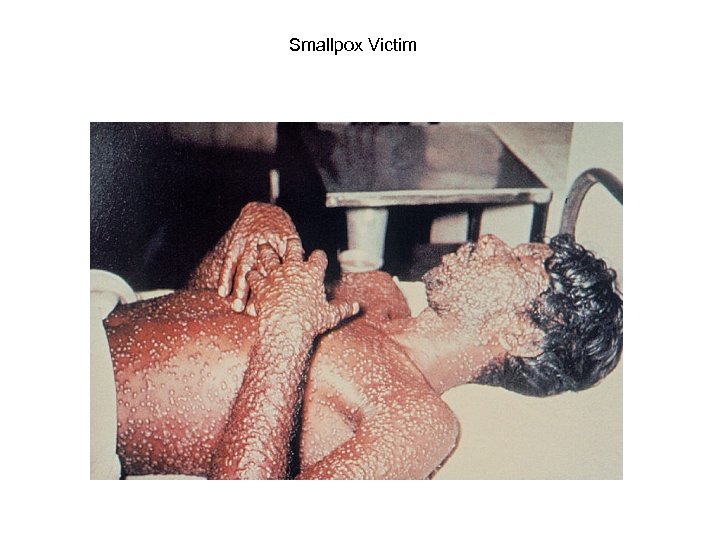 Smallpox Victim 
