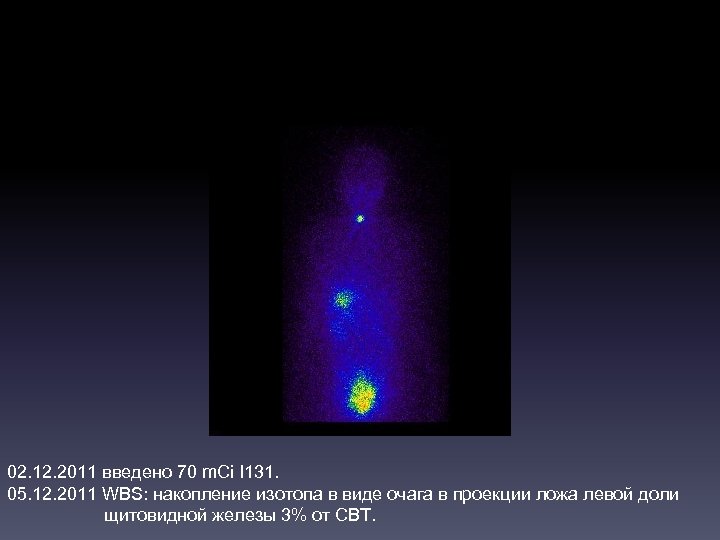 02. 12. 2011 введено 70 m. Ci I 131. 05. 12. 2011 WBS: накопление