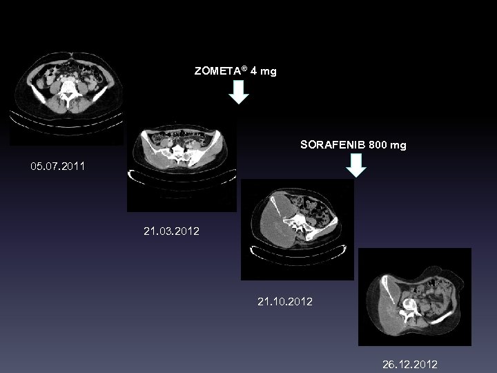 ZOMETA® 4 mg SORAFENIB 800 mg 05. 07. 2011 21. 03. 2012 21. 10.
