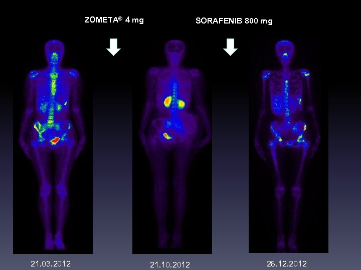 ZOMETA® 4 mg 21. 03. 2012 SORAFENIB 800 mg 21. 10. 2012 26. 12.