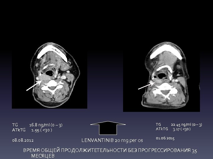 TG 16. 8 ng/ml (0 – 3) ATk. TG 1. 55 ( <30 )