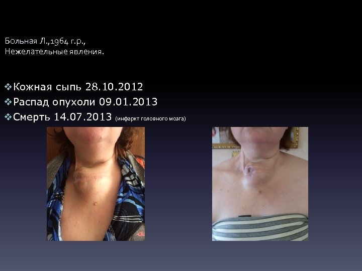 Больная Л. , 1964 г. р. , Нежелательные явления. v. Кожная сыпь 28. 10.
