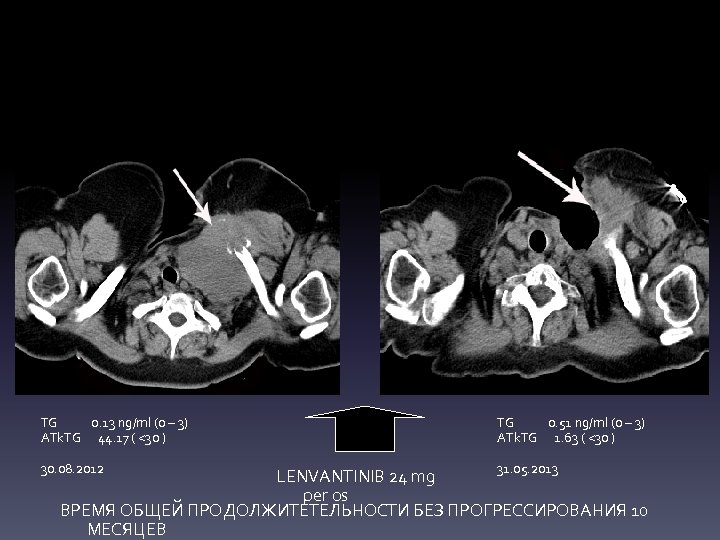 TG 0. 13 ng/ml (0 – 3) ATk. TG 44. 17 ( <30 )