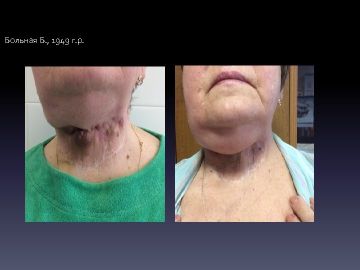 Больная Б. , 1949 г. р. 