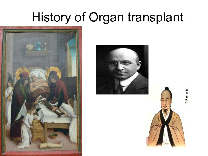 History of Organ transplant 