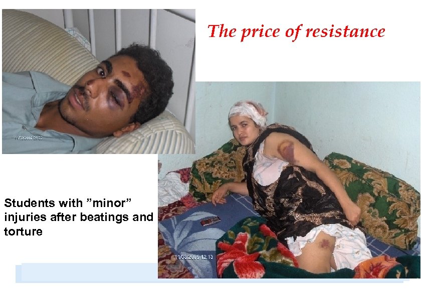 The price of resistance Students with ”minor” injuries after beatings and torture 