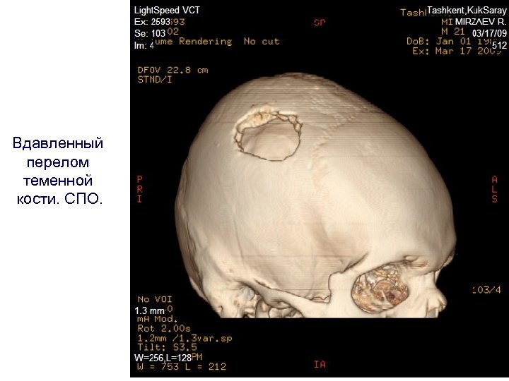 Вдавленный перелом теменной кости. СПО. 